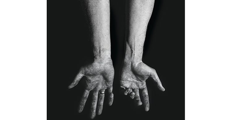 Mike Gersack's Hand After Bear Attack Image of Mike Gersack's hands after a bear attack by Ben Fullerton