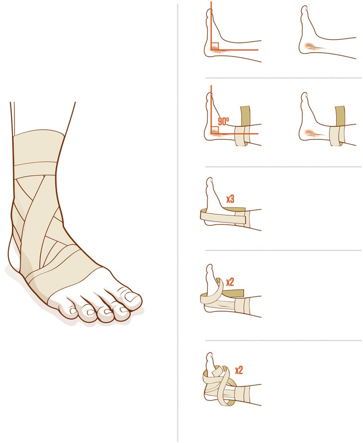 Ankle_FINAL sprained ankle