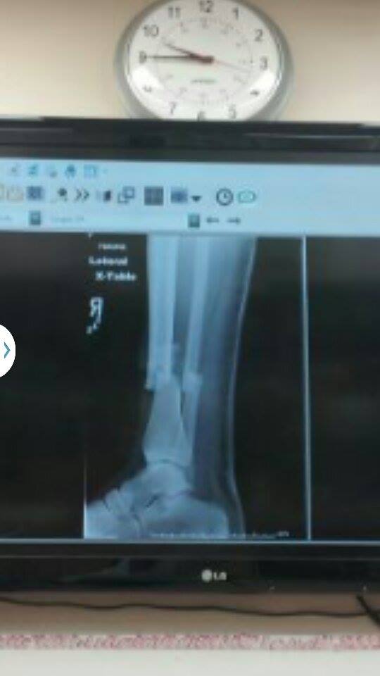 "Compound Fracture x-ray"
