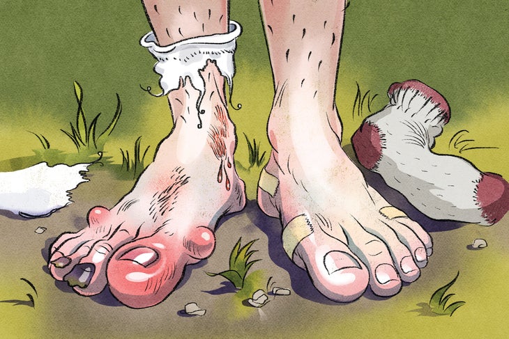 footCare Blisters