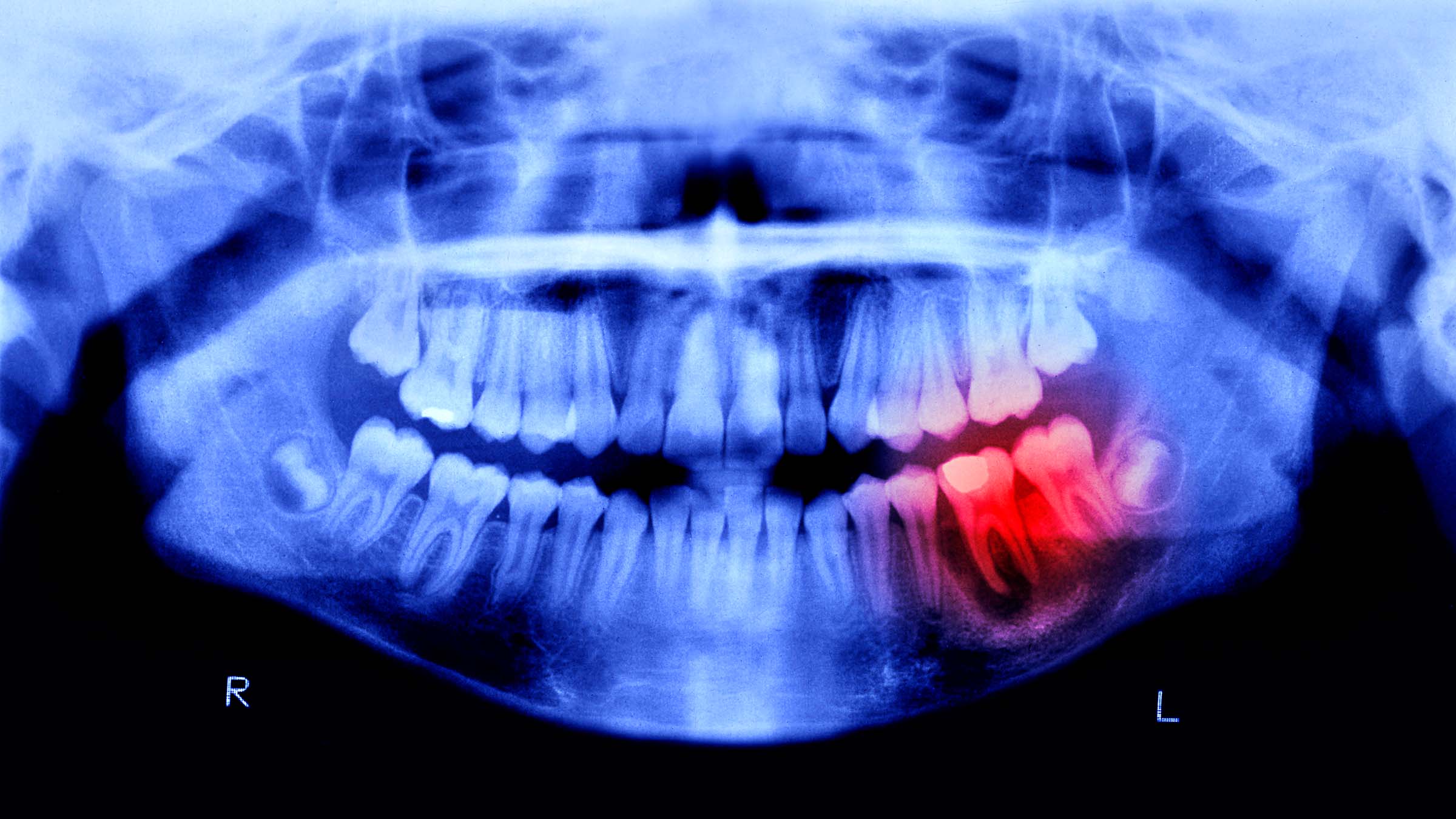 tooth x-ray
