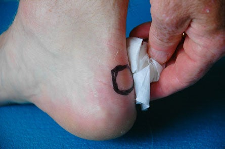 Blister-Taping-(1-of-14).jpg 28216 treat blisters